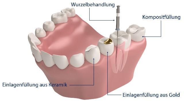 Die beste Zahnzusatzversicherung ist diejenige, die am besten zu Ihnen passt