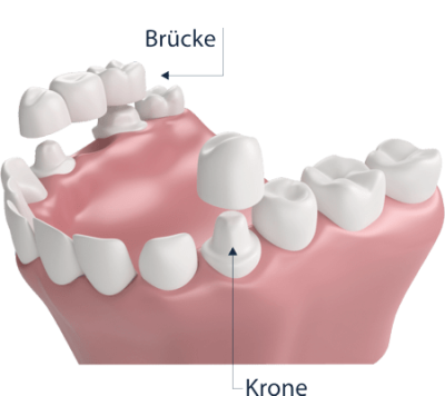 Zahnzusatzversicherung Brücke