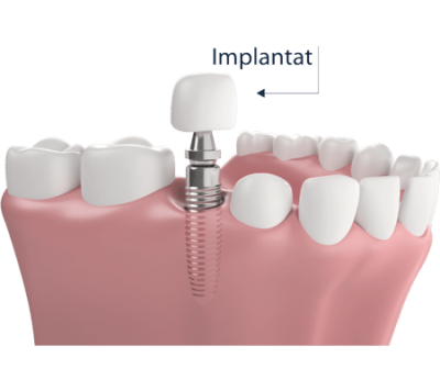 Zahnzusatzversicherung Implantat