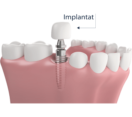 Zahnzusatzversicherung für ein Implantat mit Keramikkrone